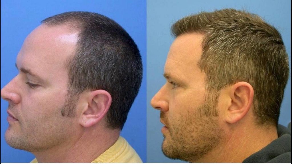 How Much Hair Transplant Cost In Philippines